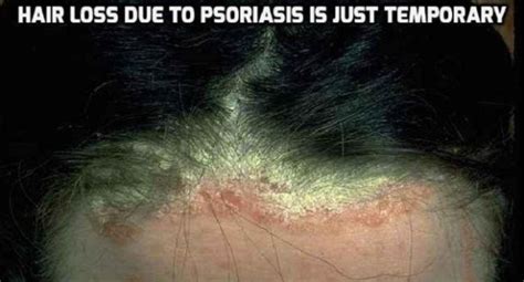 Scalp Psoriasis And Hair Loss Psoriasis Self Management
