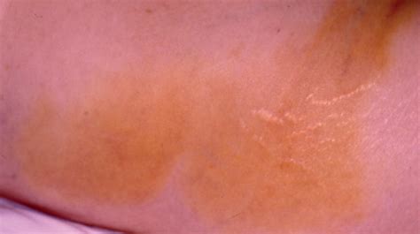 Orange Spots On Skin