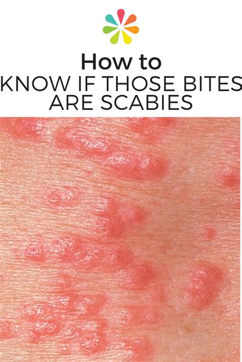 How To Know If Those Bites Are Scabies Home Remedies For Scabies
