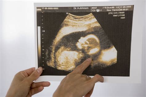 Transvaginal Ultrasound During Pregnancy