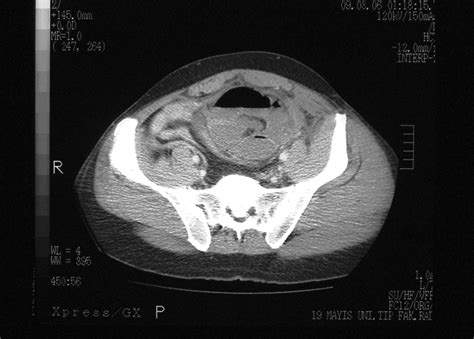 Interparietal Herniation A Rare Cause Of Intestinal Obstruction