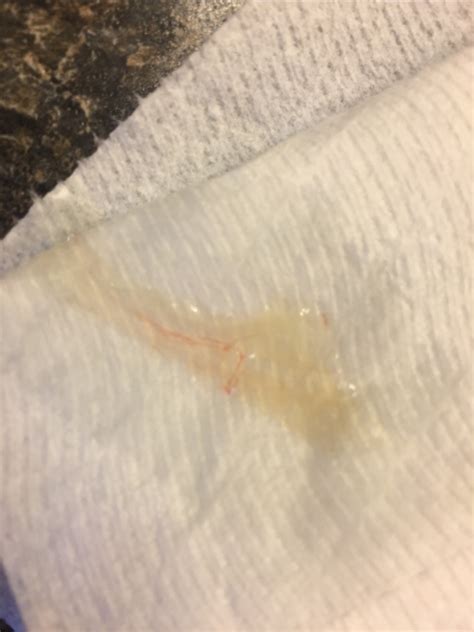 Tmi Bloody Strand In Cervical Mucus Glow Community