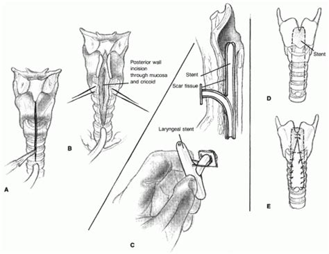 Laryngeal Stenosis Ento Key