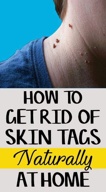 best remedies to get rid of skin tags naturally beauty4everything