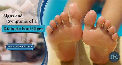 Be Cautious Of The Signs And Symptoms Of A Diabetic Foot Ulcer