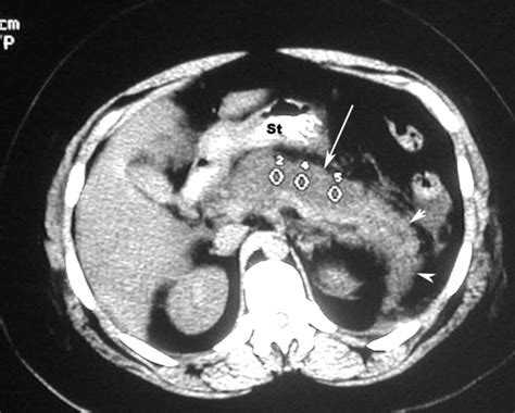 Acute Pancreatitis Pancreatic Necrosis