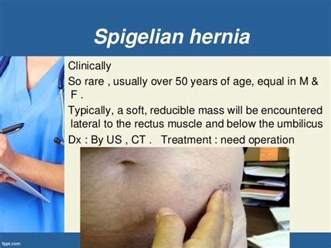 Spigelian Hernia Symptoms