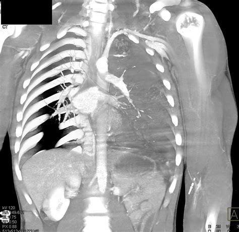 Gsw With Lung Bone And Muscle Injury Chest Case Studies Ctisus Ct