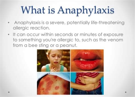 Anaphylaxis An Overview Health And Medical Information