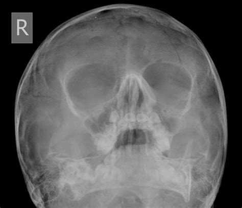 Frontal bone fracture with subdural haematoma | Image ...