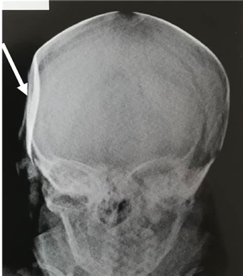 X Ray Of Skull Fracture Images