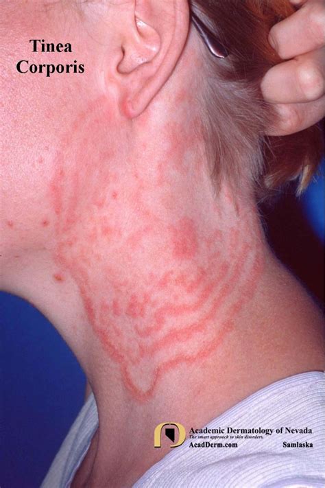 Tinea Corporis Ringworm Tinea Circinata Academic Dermatology Of