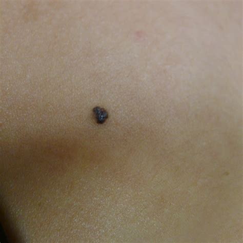 Skin Cancer Symptoms Pictures Photos Types Signs Melanoma