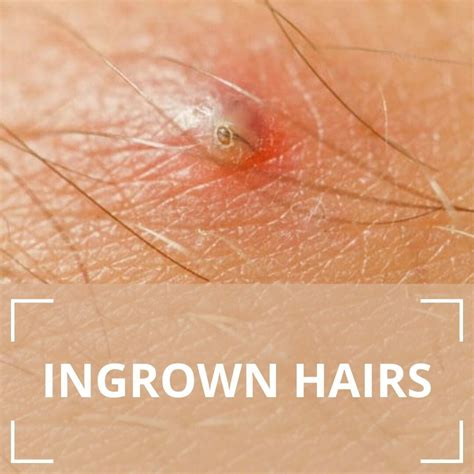 Ingrown Hairs London Premier Laser Skin Clinic