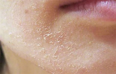 Маски от шелушения кожи на лице в домашних условиях