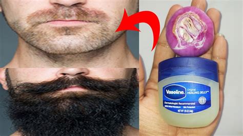 How To Grow Beard Faster Naturally At Home With Onion And Vaseline
