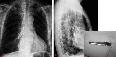 Two Interesting Cases Of Tracheobronchial Foreign Bodies Bmj Case Reports