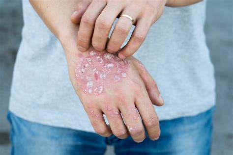 Top 7 Causes For Psoriasis American Academy Of Medicine And Nutrition