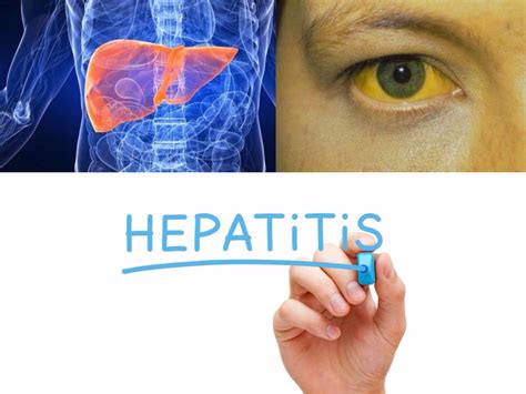 Deteksi Hepatitis Sejak Dini K Klik