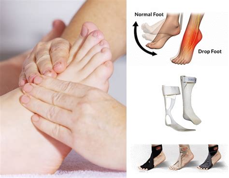 Foot Drop Causes Signs Symptoms And Treatment In Malaysia