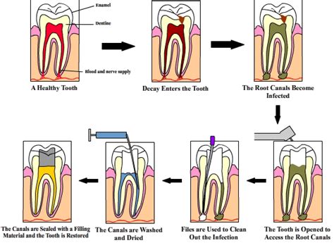 Several adjuncts to emergency pulpotomy and pulpectomy procedures are available and must be considered. Dental Assistant Guide to Root Canal Treatment ...