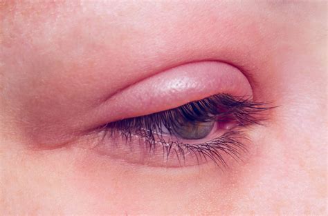 Upper Eyelid Flip Floppy Eyelid Syndrome Eye Lid Laxity Ectropion