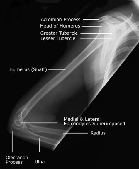 Medical And Health Science Humerus Lateral