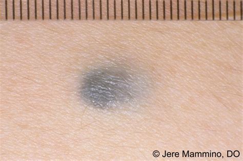Blue Nevus American Osteopathic College Of Dermatology Aocd