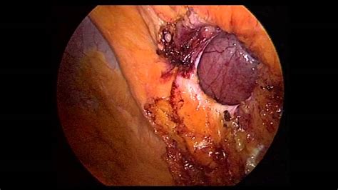 Laparoscopic Umbilical Hernia Repair With A Composite Mesh Youtube