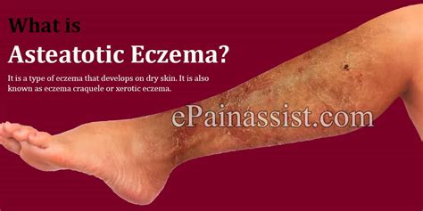 What Is Asteatotic Eczemacausesrisk Factorssymptomstreatmenthome