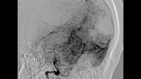 Diagnostic Cerebral Angiography And Technique Of Vertebral Artery