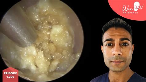 1207 White Rock Solid Ear Wax Removal And Keratin Chisel Youtube
