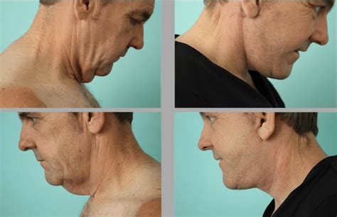 Best Neck Lift Surgery In Mexico Vida Wellness And Beauty
