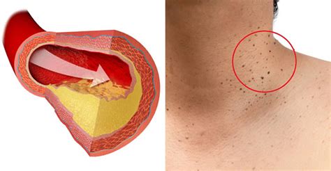 We did not find results for: Sintomi e cause dei trigliceridi alti, e come abbassarli ...