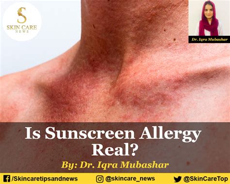 Is Sunscreen Allergy Real