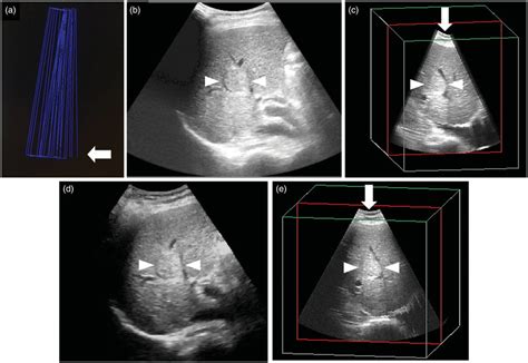 Comparison Of Three Dimensional Ultrasound 3dus Volume Data Images