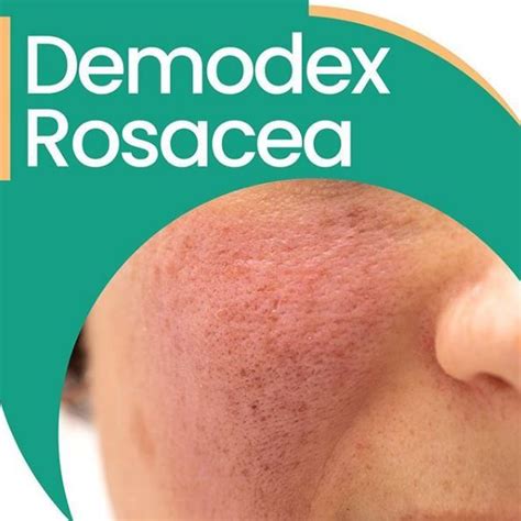 Rosacea And Demodex Mites Demodex Demodex Mites Demodex Treatment