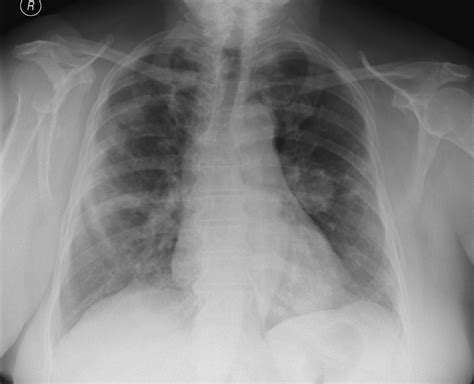 Ultrazvuk může zobrazit trombus v žilách dolních končetin, echokardiografické vyšetření může zobrazit přetížení pravé komory srdeční (v důsledku obstrukce plicnice). Sono Atlas - nález