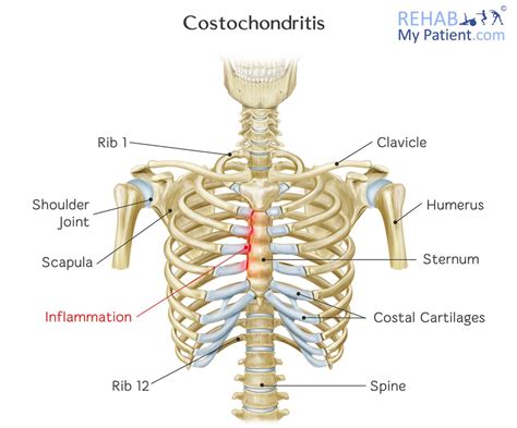 The chest consists of the furcula (wishbone) and coracoid (collar bone) which, together with the scapula, form the pectoral girdle; Costochondritis | Rehab My Patient