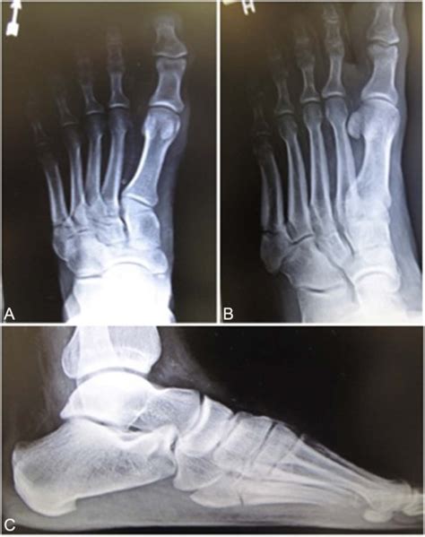 Early Weightbearing Protocol In Operative Fixation Of Acute Jones Fractures The Journal Of