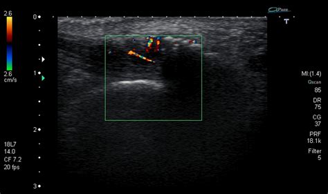 Ultrasound Images Of Insertional Achilles Tendinopathy Ankle Foot
