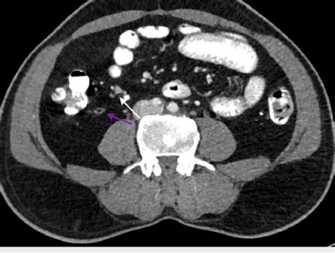 Contrast Enhanced Ct Abdomen Axial View Showing Normal Appendix With