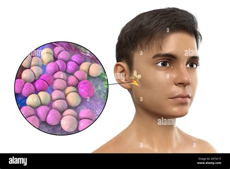 otitis media ear infection caused by streptococcus pneumoniae bacteria conceptual computer