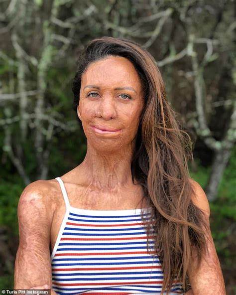 Turia Pitt Explains The Process Of Recovering From Her Devastating Burns Readsector