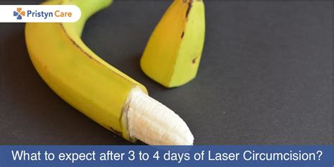 What To Expect After 3 To 4 Days Of Laser Circumcision Pristyn Care