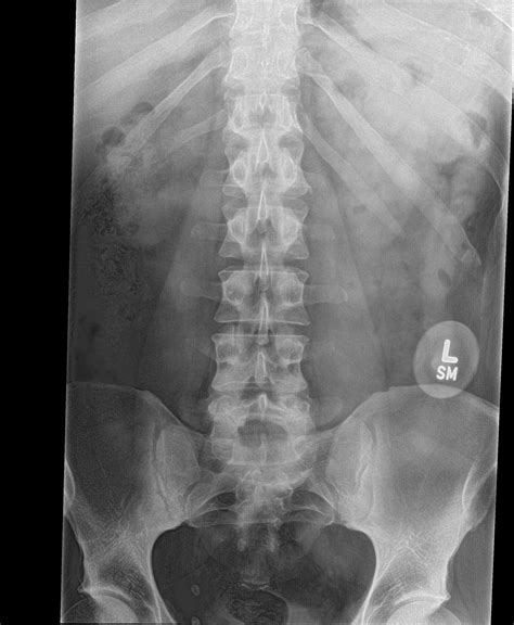 Ap Lumbar Spine Xray