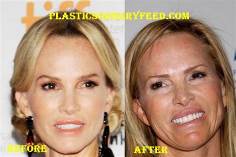Janet Gretzky Plastic Surgery Plastic Surgery Feed