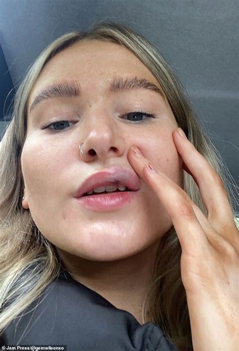 Woman 20 Warns Of Dangers After Nearly Losing Her Lips After Filler