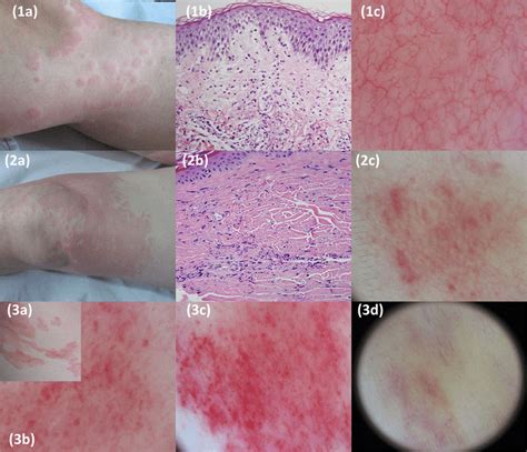 Clinical Histological And Dermoscopic Features Of Chronic Spontaneous