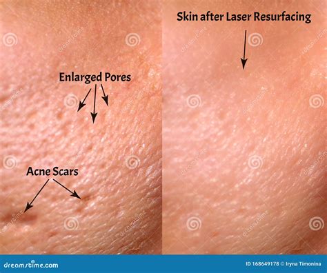 Comparison Of Skin Before And After Laser Resurfacing Skin With Acne